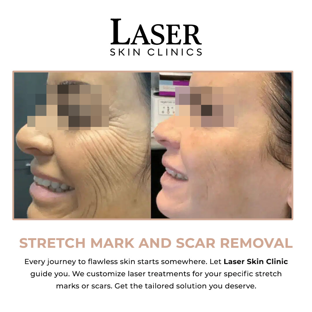 Stretch Mark & Scar Removal