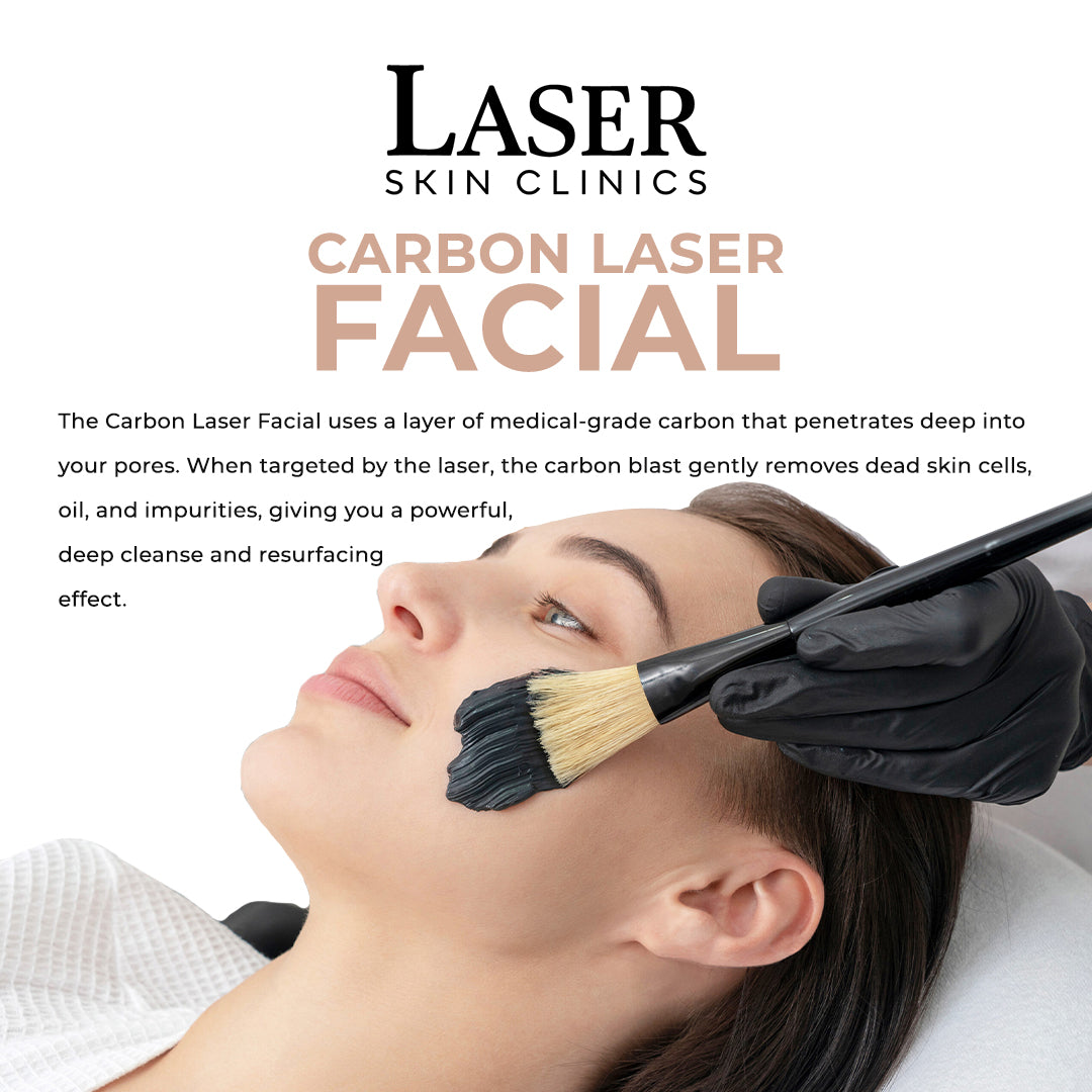 Carbon Laser Facial