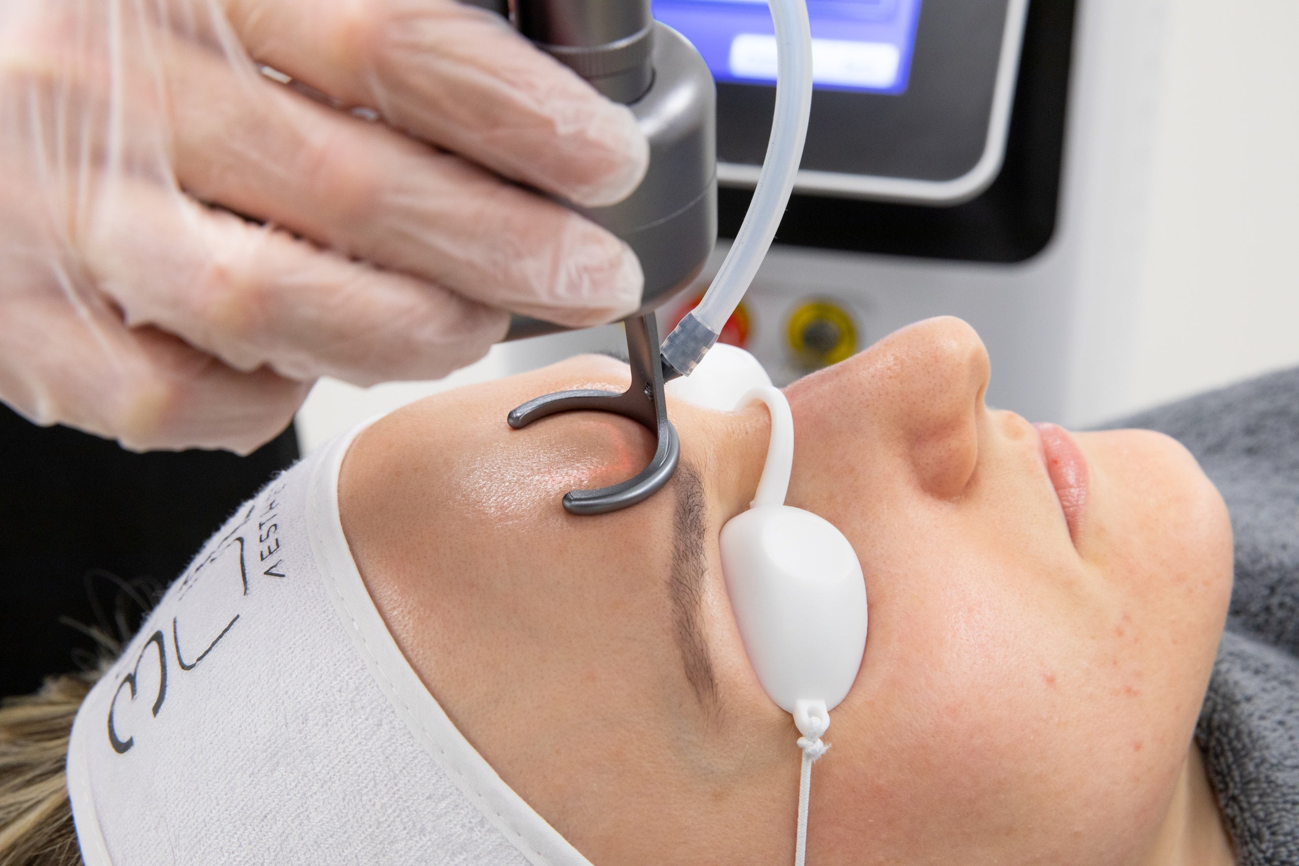 CO2 Laser Resurfacing