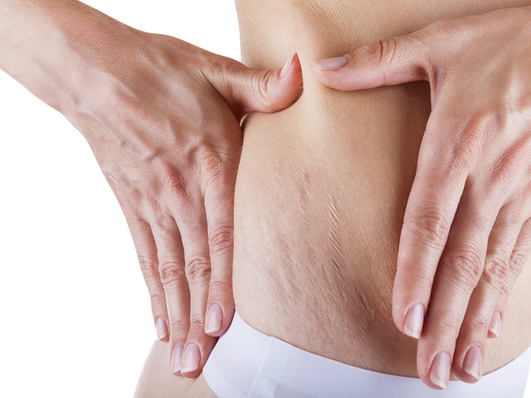 Stretch Mark & Scar Removal