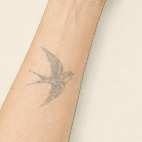 The same tattoo visibly faded after three laser sessions