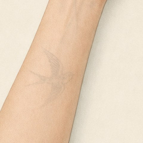 The same tattoo reduced to a faint ghost after six sessions