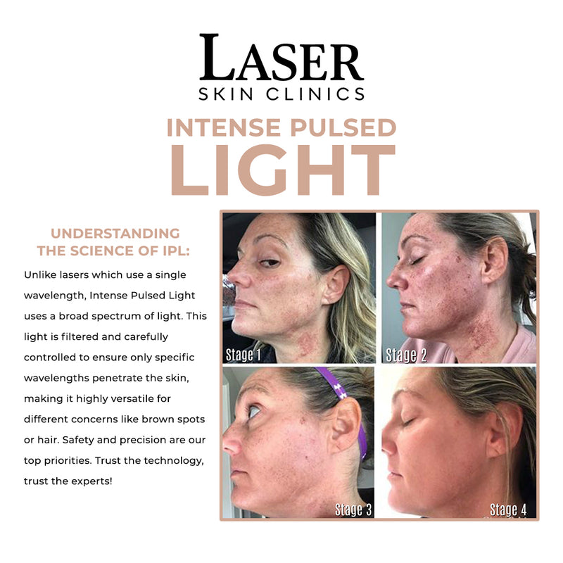 IPL Glo Facial