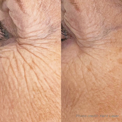Dermaforce RF Microneedling