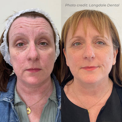 Dermaforce RF Microneedling