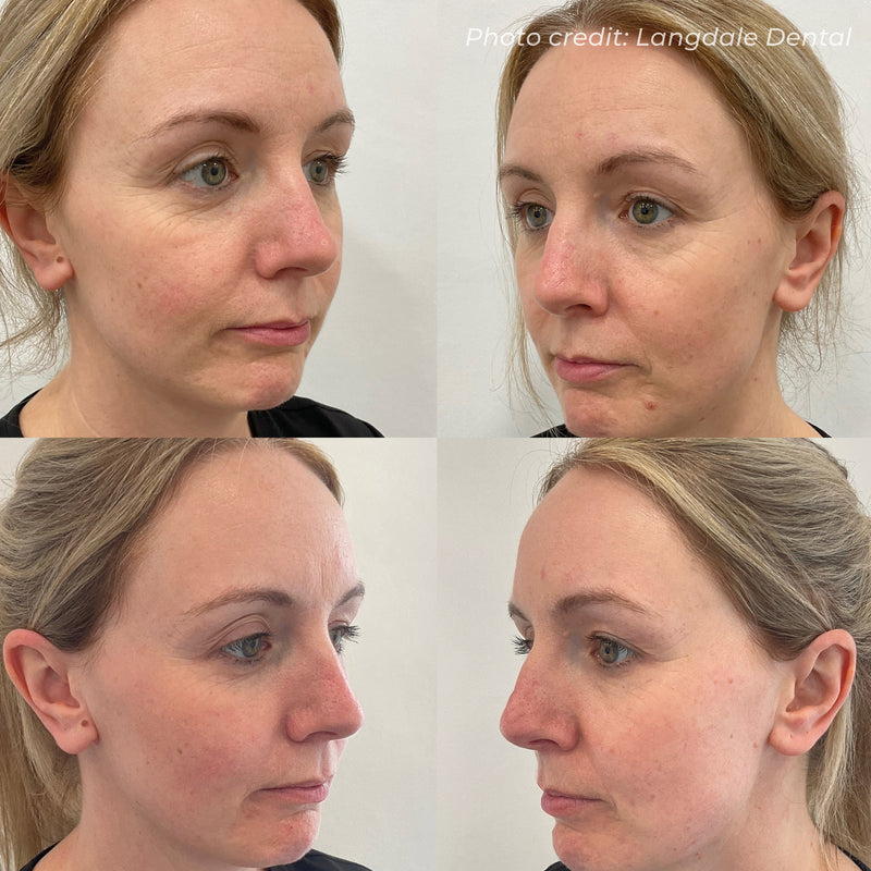 Dermaforce RF Microneedling