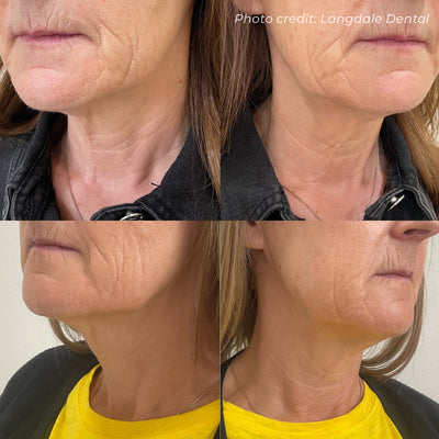 Dermaforce RF Microneedling