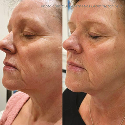 Dermaforce RF Microneedling