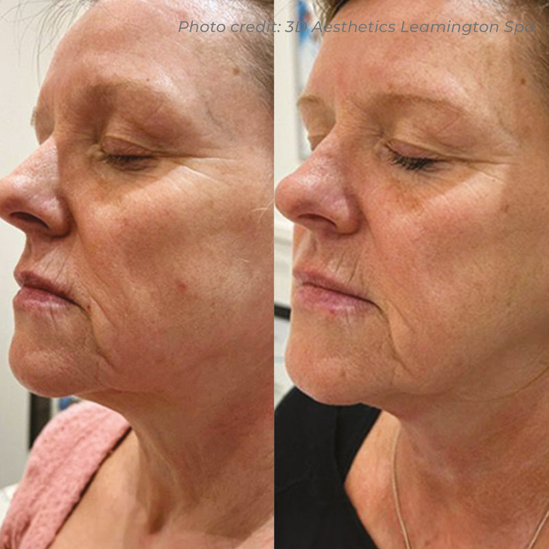 Dermaforce RF Microneedling