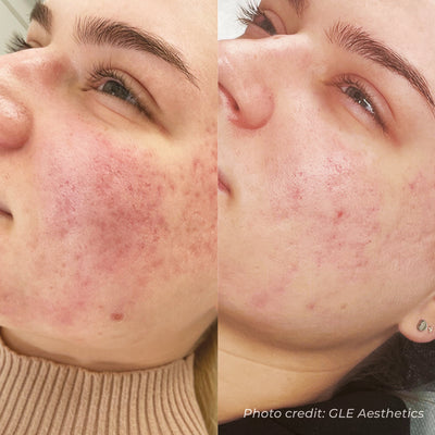 Dermaforce RF Microneedling