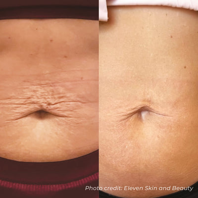 Dermaforce RF Microneedling