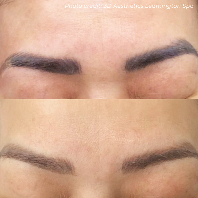 Laser Tattoo Removal