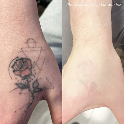 Laser Tattoo Removal