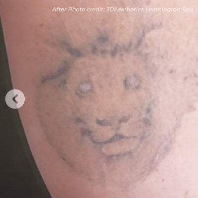 Laser Tattoo Removal