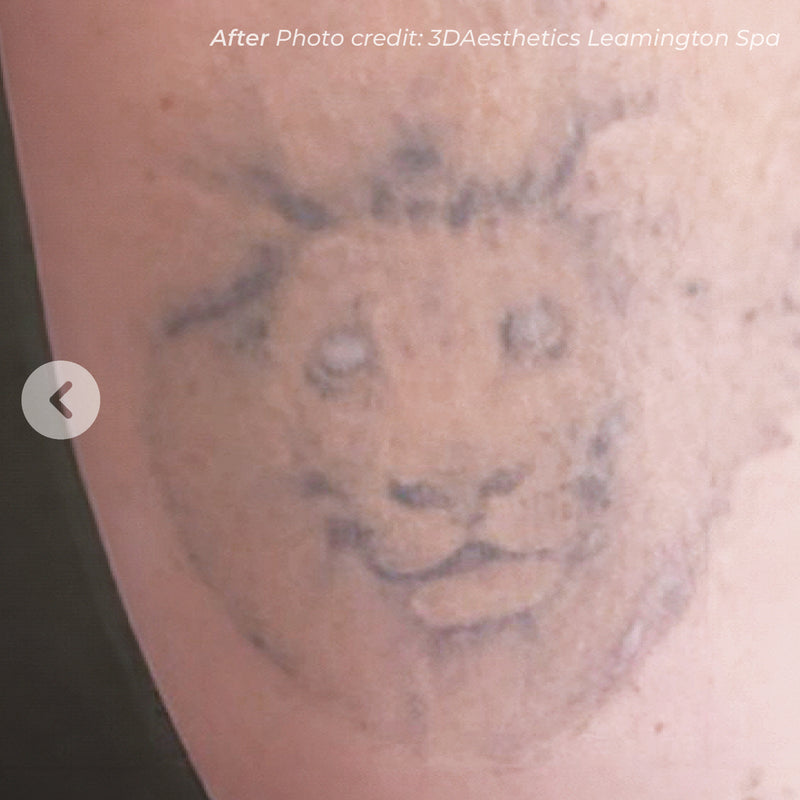Laser Tattoo Removal