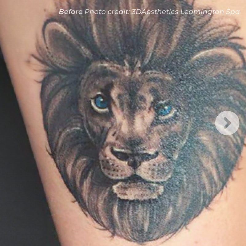 Laser Tattoo Removal