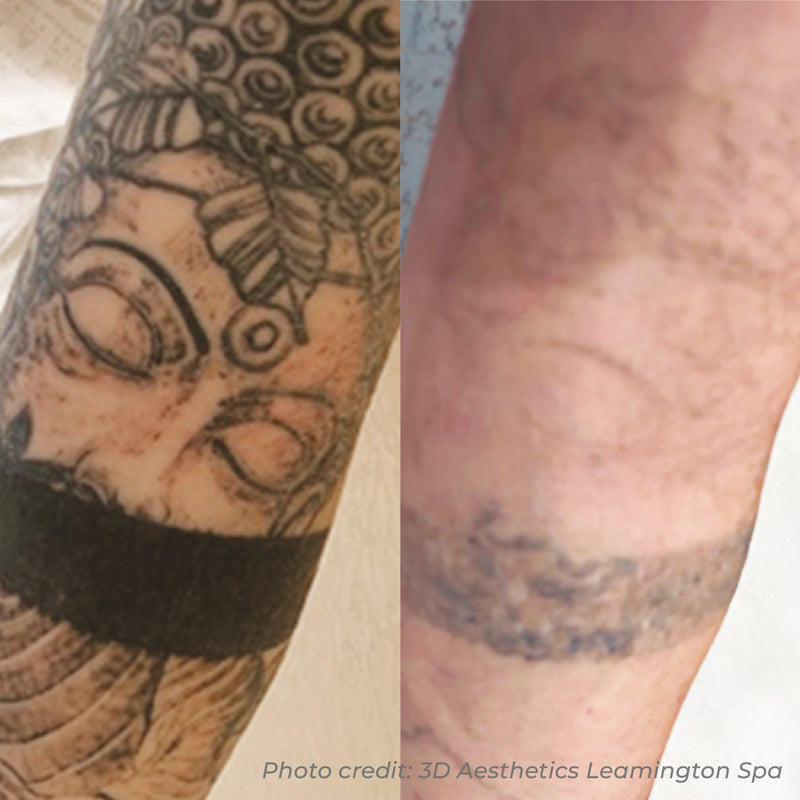 Laser Tattoo Removal
