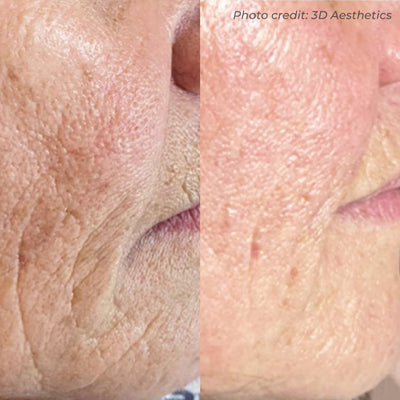 Dermaforce RF Microneedling