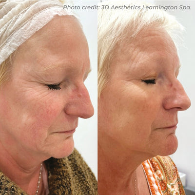Dermaforce RF Microneedling