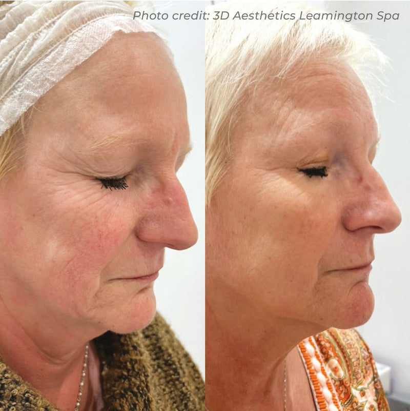 Dermaforce RF Microneedling
