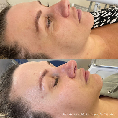 Dermaforce RF Microneedling