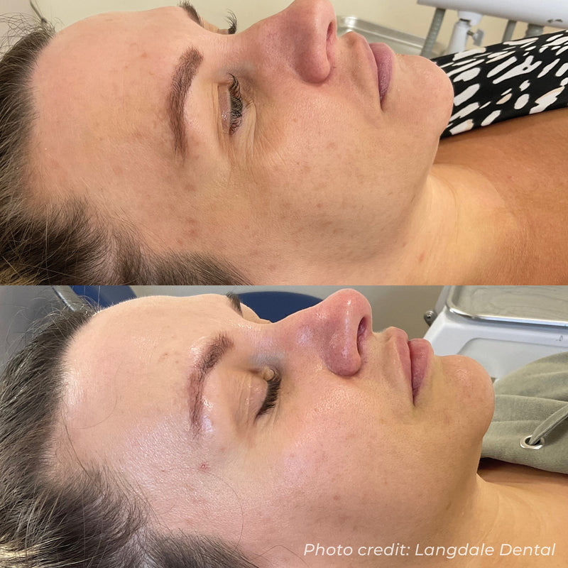 Dermaforce RF Microneedling