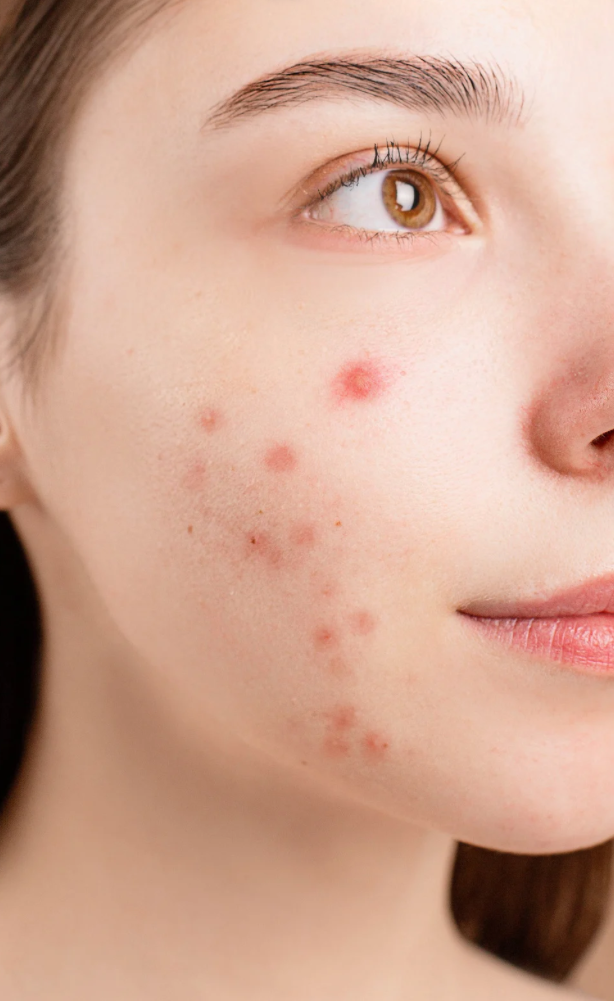 Acne Treatment