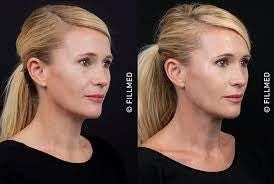 NCTF  Skin Booster