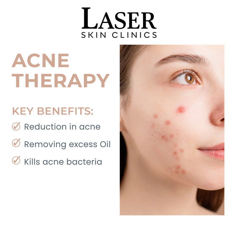 Acne Therapy