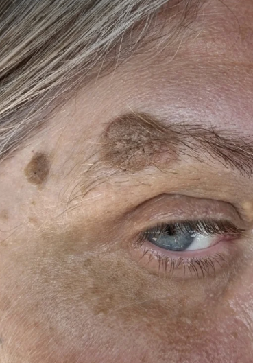 Before Mole Removal treatment at Laser Skin Clinics Wolverhampton