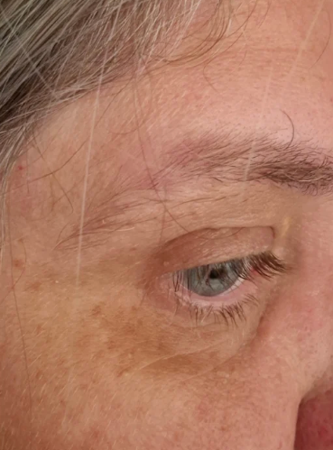 After Mole Removal treatment at Laser Skin Clinics Wolverhampton