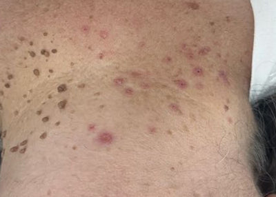 After Skin Tag Removal, Neck treatment at Laser Skin Clinics Wolverhampton