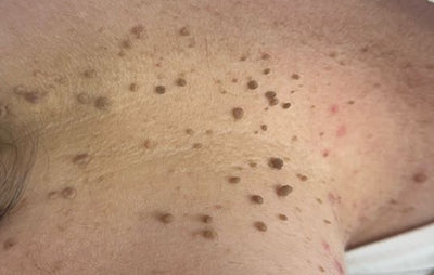 Before Skin Tag Removal, Neck treatment at Laser Skin Clinics Wolverhampton