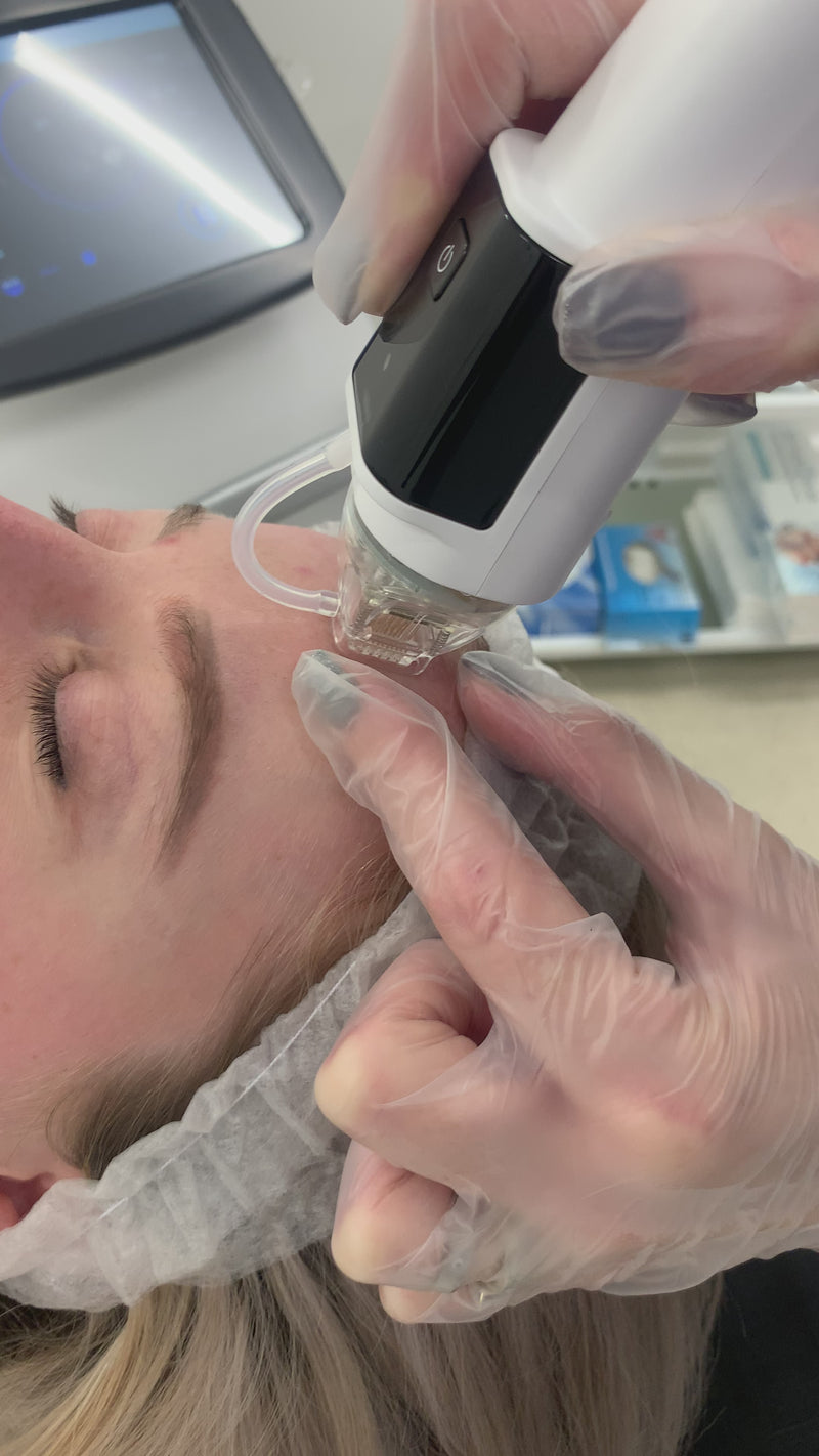 Dermaforce RF Microneedling