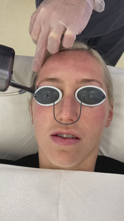 CO2 Laser Resurfacing