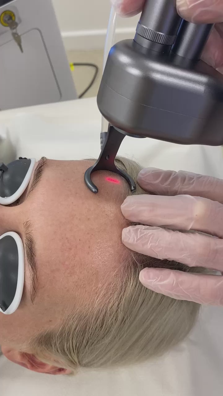 CO2 Laser Resurfacing