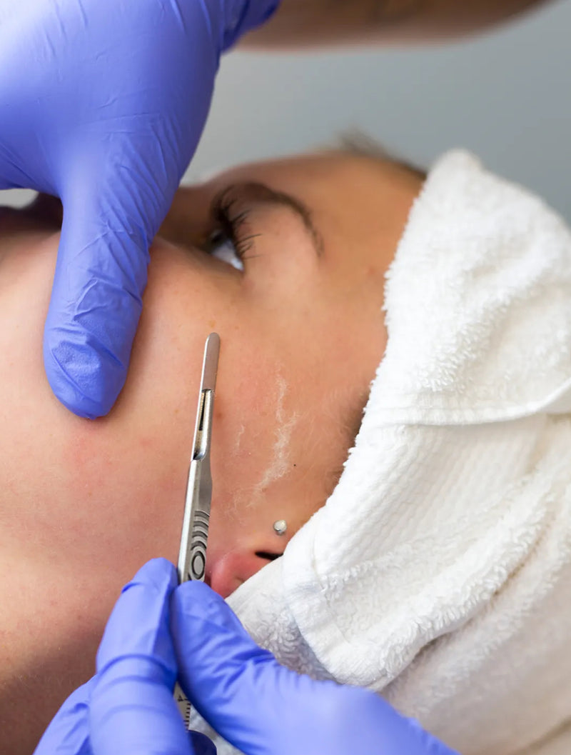 Dermaplaning