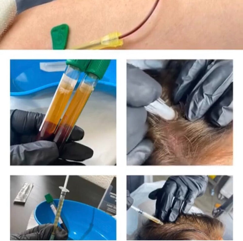 PRP Hyaluronic Acid Facial