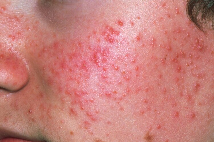 Acne Treatment