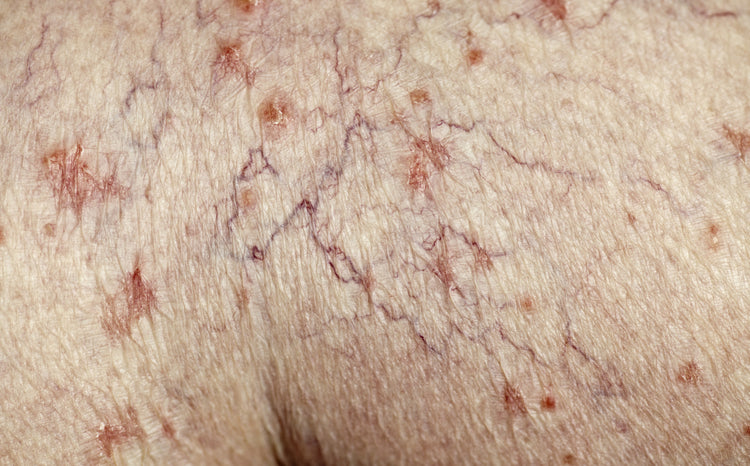 Red and Thread Vein Treatment