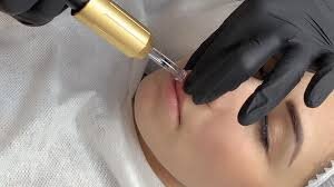 Hyaluron Pen Cosmetic Filler
