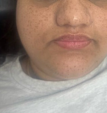 After Age Spot Treatment, Face treatment at Laser Skin Clinics Wolverhampton
