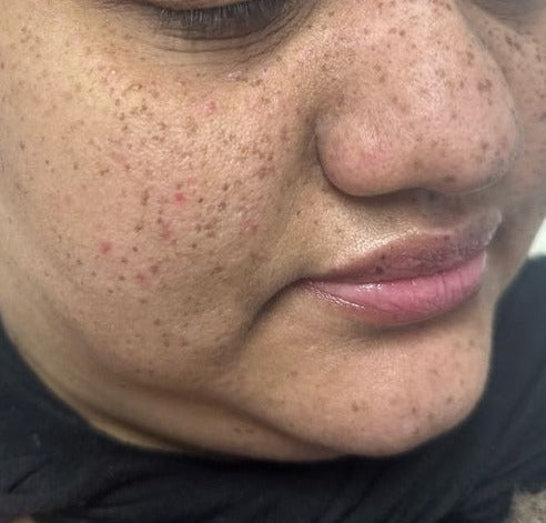 Before Age Spot Treatment, Face treatment at Laser Skin Clinics Wolverhampton
