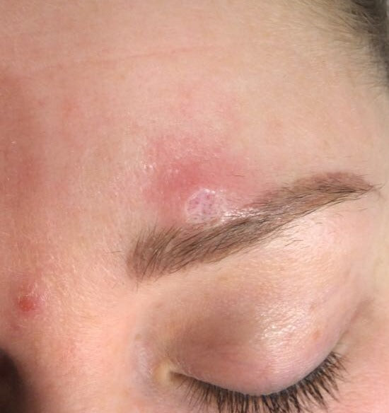 After Cherry Angioma Removal, Brow treatment at Laser Skin Clinics Wolverhampton