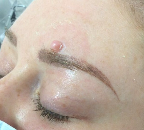 Before Cherry Angioma Removal, Brow treatment at Laser Skin Clinics Wolverhampton