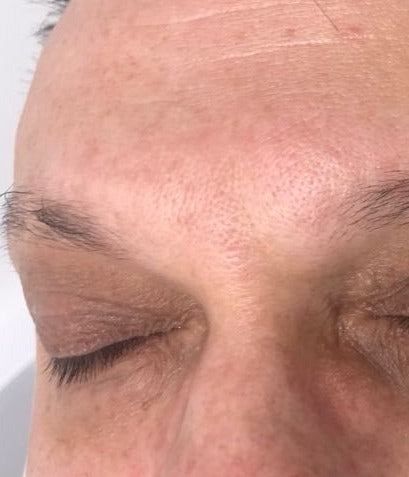 After Milia Removal, Brow treatment at Laser Skin Clinics Wolverhampton
