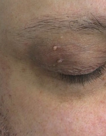 Before Milia Removal, Brow treatment at Laser Skin Clinics Wolverhampton