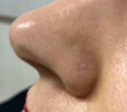 After Nose Mole Removal treatment at Laser Skin Clinics Wolverhampton