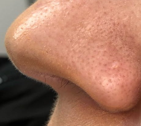 Before Nose Mole Removal treatment at Laser Skin Clinics Wolverhampton