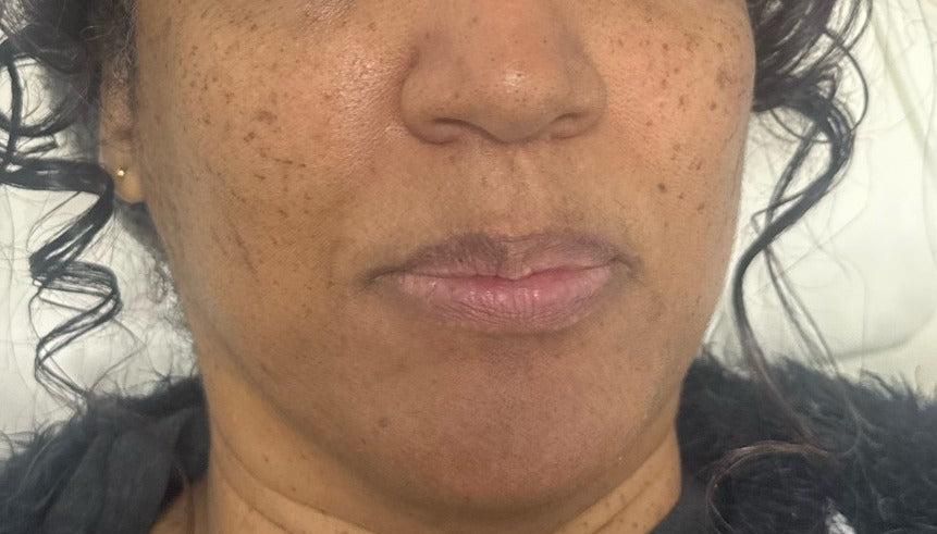 After Seborrhoeic Wart Removal, Cheeks treatment at Laser Skin Clinics Wolverhampton